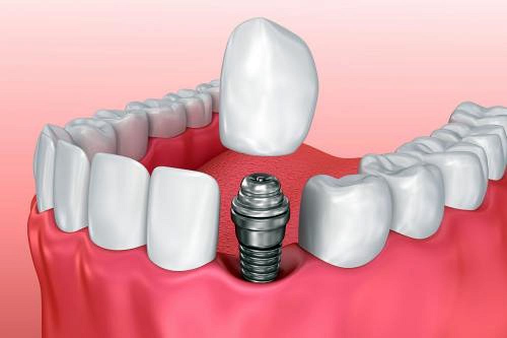 Implantes Dentales