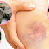 How to Get Rid of Bruises Naturally (According to Research)