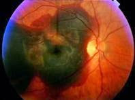 Age-related Macular Degeneration