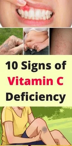 Here 10 Signs Of Vitamin “C” Deficiency!!!