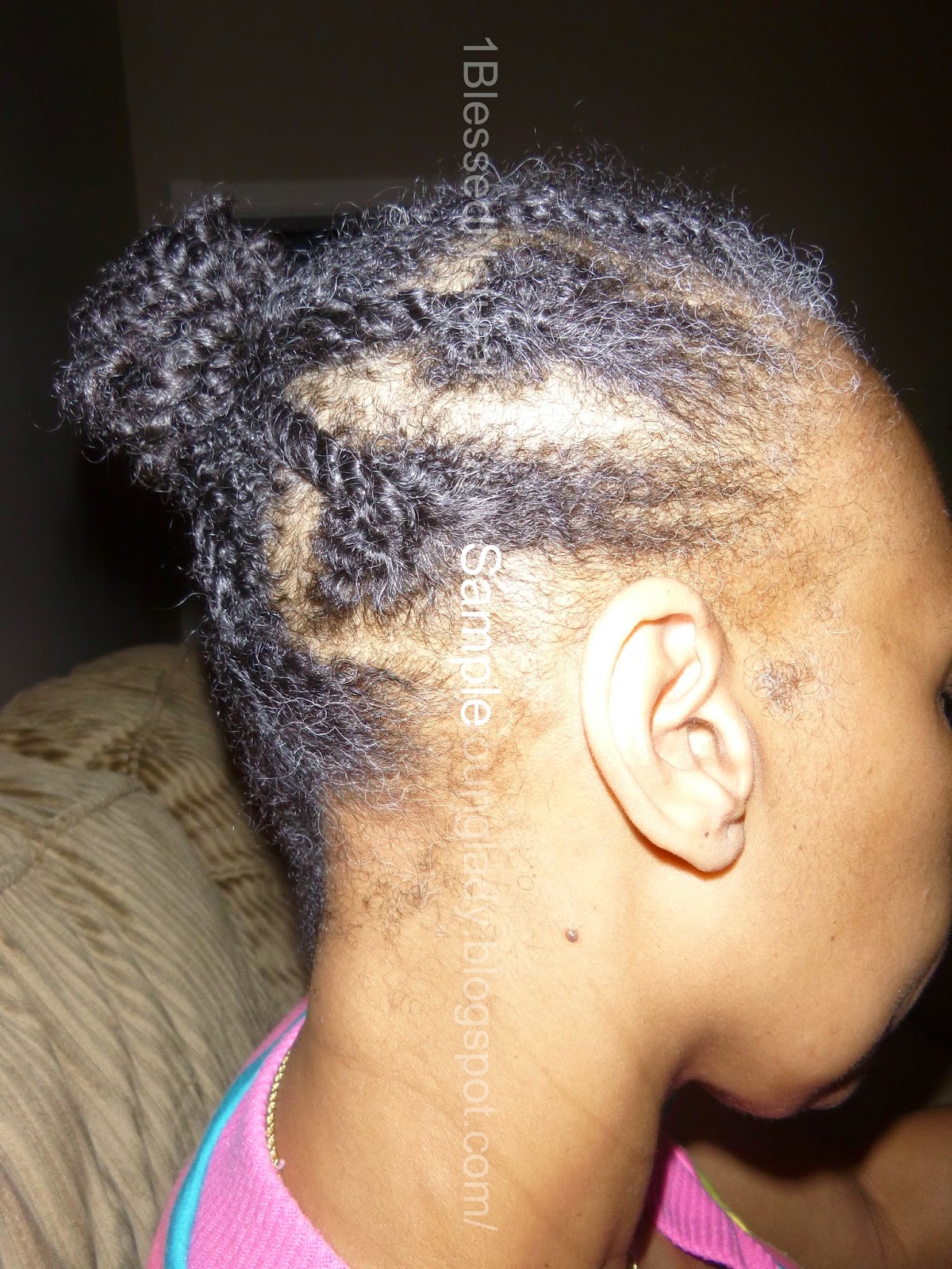 Natural Treatments For Alopecia - Here Are Your Options