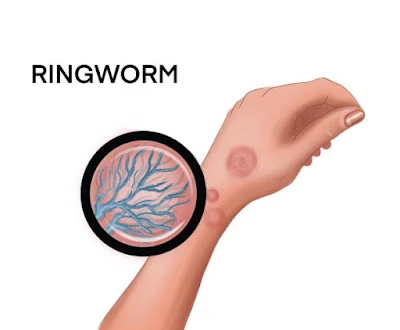 ringworm