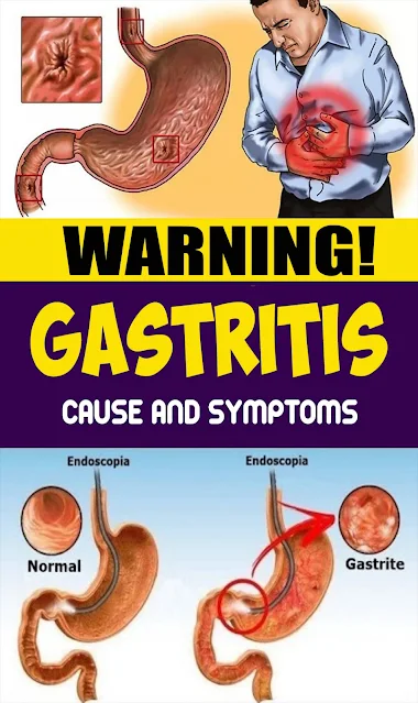 Gastritis – Causes And Side Effects