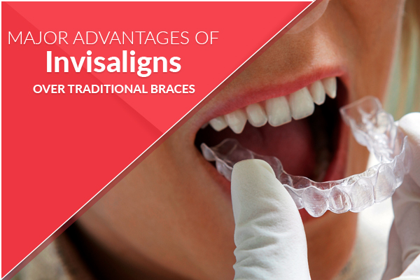 Advantages of Invisaligns over Traditional Braces