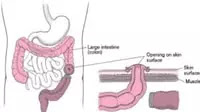 Strangulation of Intestine