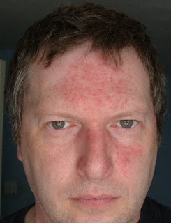 Rosacea Tratamiento