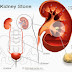 How to prevent kidney stones? சிறுநீரகத்தில் கற்கள் எப்படி தடுப்பது ?