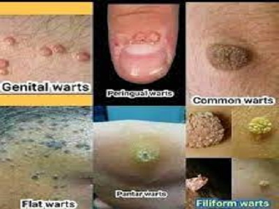 Various Treatment Of Warts