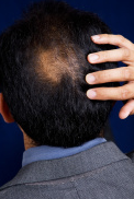 5 Preventing Grey Hair and Hair thinning treatment For LOVERS