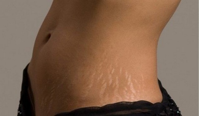 Bahan Alami untuk Memudarkan Stretch Marks