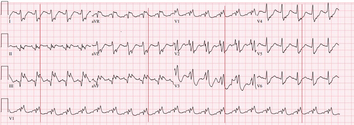 Dr Smith S Ecg Blog Teach Your Learners When The Qrs Is Wide The J Point Will Hide So Trace It Down And Copy It Over