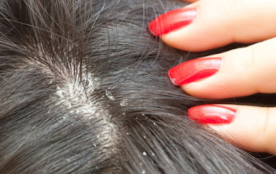 how to get rid of dandruff home remedies