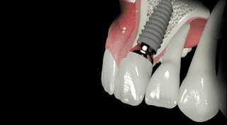 Quy trình cấy ghép răng Implant-1