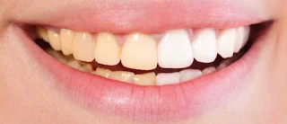 Precautions for teeth whitening