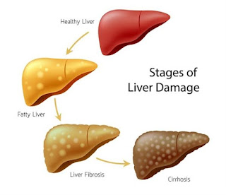Pharmacotherapy of liver cirrhosis