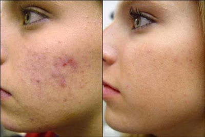 Tratamento para cicatrizes de acne