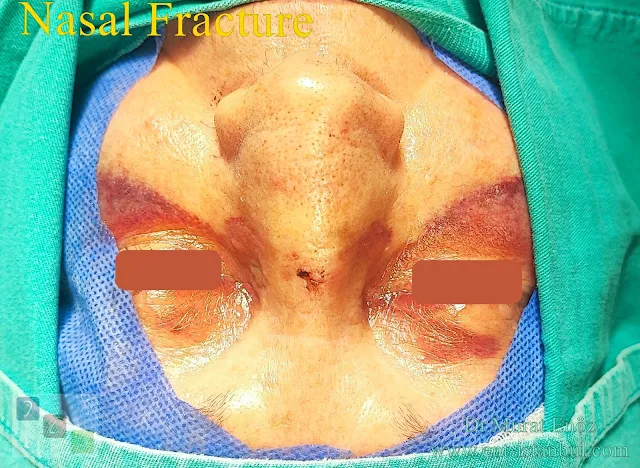 Nasal fracture,Nasal fracture diagnosis,Broken nose,Nosefracture reduction,Post-operative instructions for reduction nasal fracture,