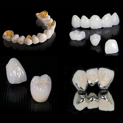 Có nên trồng răng sứ titan cho răng hàm?