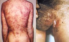 Obat Kencing Nanah Alami Obat Kencing Nanah Alami