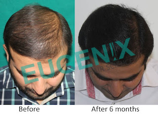 http://eugenix.in/trichologist-in-delhi/