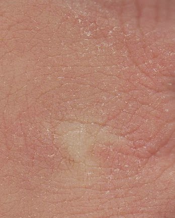 http://commons.wikimedia.org/wiki/File:Xeroderma_knuckles.jpg