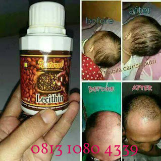 obat kebotakan