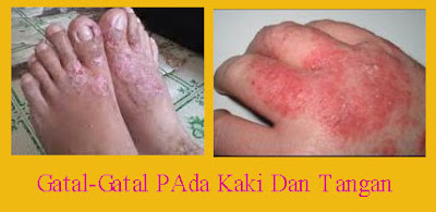 Cara Ampuh Obati Gatal Eksim Di JAri Kaki Dan Jari Tangan