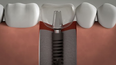 Cấy ghép implant có đau không?