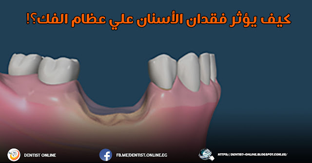 bone loss after teeth extraction