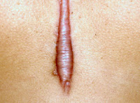 Keloid