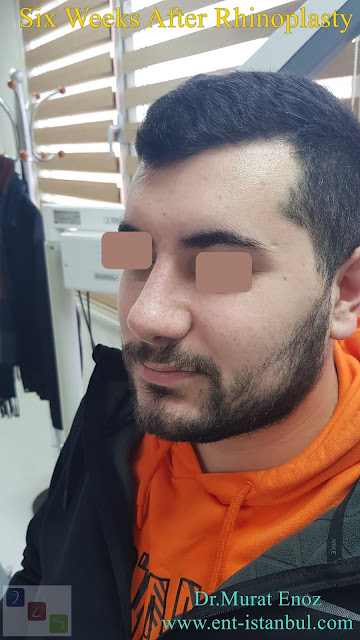 Male nose job Turkey. Nose aesthetic surgery for men,Rhinoplasty in Men Istanbul,