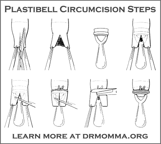 Circumcision Aftercare - Post Procedure Care - Russell Medical