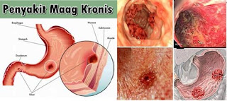 Maag Akut dan Kronis