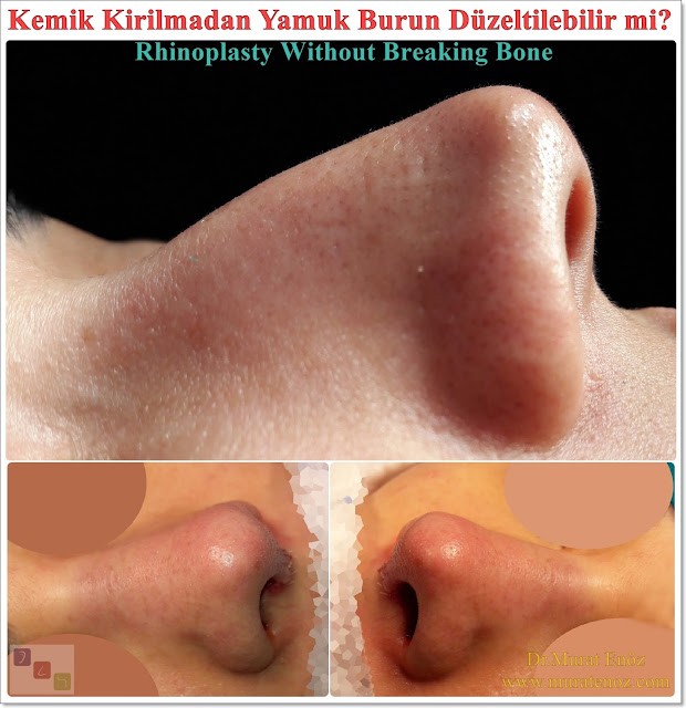 Asymmetric nose correction without bone broken - Rhinoplasty without breaking bone for deviated noses - Nose aesthetic without breaking bone - Nose aesthetic for curved noses - Nose tip aesthetics - Rhinoplasty without breaking bone - Rhinoplasty in istanbul - Tip plasty in istanbul - Nose job without breaking the nasal bone in Istanbul - Deviated nose surgery - Curved nose correction without nsal bone breaking - Using of cartilage paste in rhinoplasty