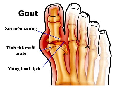 Nấm lim xanh điều trị bệnh gout