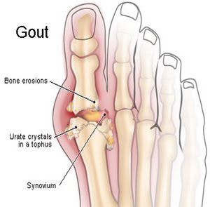 Treatment for Gout in Foot: Pain Treatment Guidelines