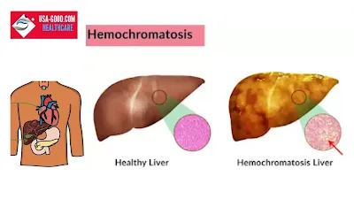 What is Hemochromatosis?