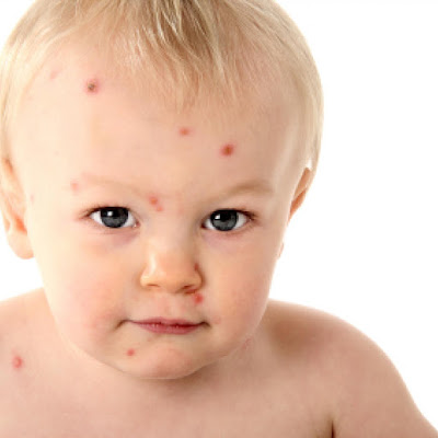 chickenpox,chickenpox disease,chickenpox treatment