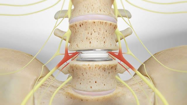 What Are The Risks Involved in Cervical Disc Surgery? How Can You Recover From It?