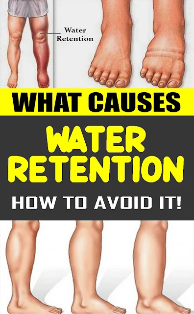 6 Things That Cause Fluid Retention in Your Body and How to Avoid Them