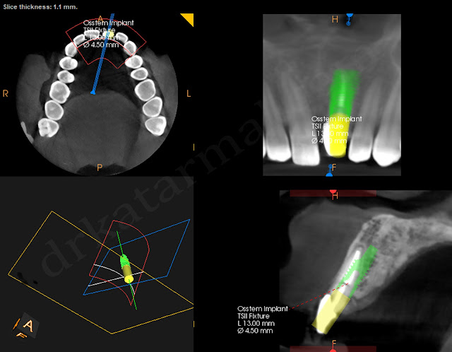 CBCT for Dental Implant Planning