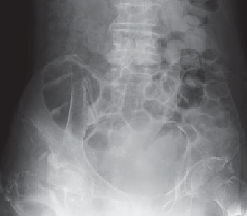 Rectosigmoid Junction Location, Polyp, Cancer, Surgery