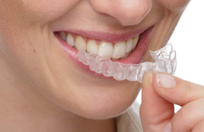 Phương pháp niềng răng không nhổ răng có gì tốt?