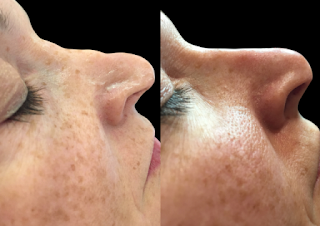 non surgical rhinoplasty before and after