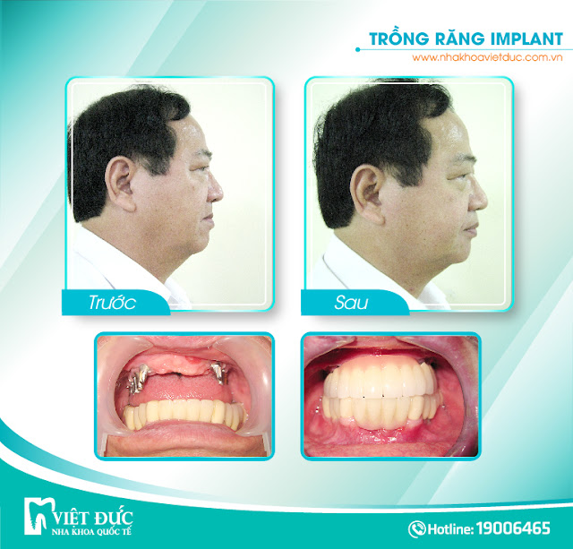 Trần Quang, 57 tuổi, Hà Nội, cấy Implant 12 răng hàm trên và làm hàm tháo lắp