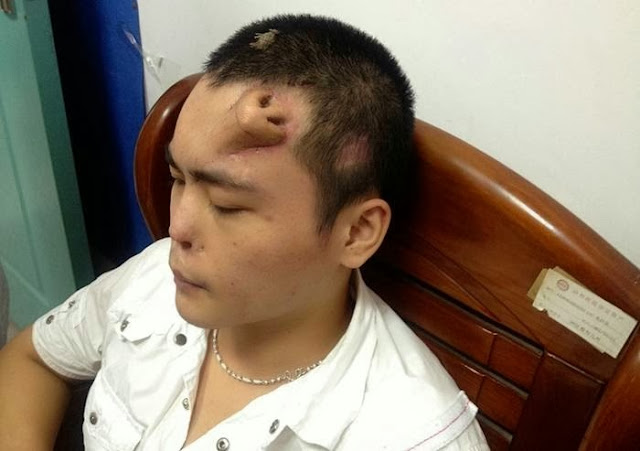 Chinese Doctors Grow Nose on Man's Forehead