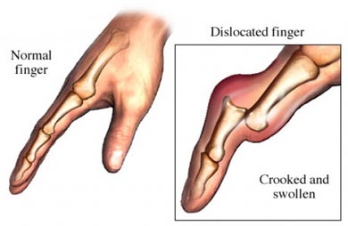 Free For Health: Congenital Hip Dislocation - Symptoms and 