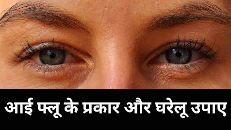 Eye flu home treatment in hindi-आई फ्लू से छुटकारा दिलाएंगे ये सरल घरेलू उपाए