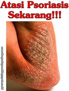 Obat Psoriasis