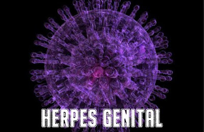 Cara Mengobati Herpes Genitalis